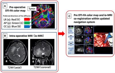 Combining Pre-operative Diffusion Tensor Images and Intraoperative Magnetic Resonance Images in the Navigation Is Useful for Detecting White Matter Tracts During Glioma Surgery